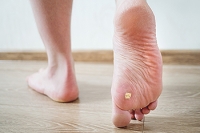 Facts About Plantar Warts