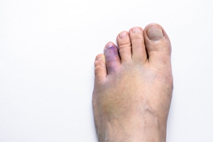 Understanding Broken Toes and Their Symptoms