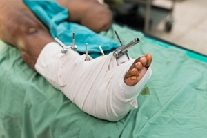 External Fixation for Broken Ankles