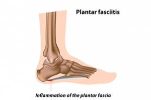 Causes, Symptoms, and Possible Relief Options for Plantar Fasciitis