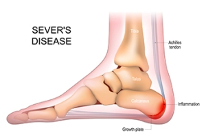 Sever’s Disease and Heel Pain in Active Children