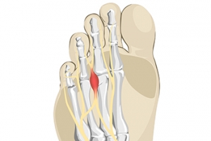 Utilizing Imaging Tests for Diagnosis and Treatment of Morton’s Neuroma