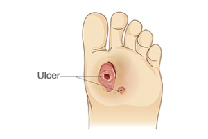 How Diabetic Foot Ulcers Begin