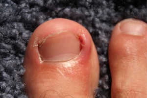 Possible Causes Of An Ingrown Toenail