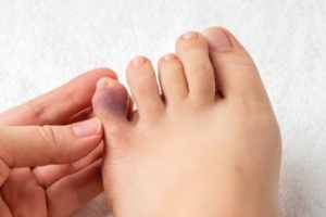 What Happens With a Broken Toe