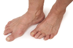 How Rheumatoid Arthritis Affects the Feet and Ankles