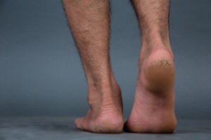 Why Cracked Heels Happen