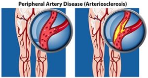 Buerger Disease