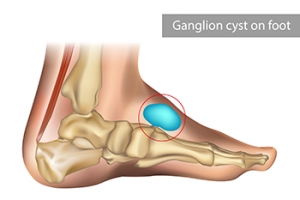 Explaining Ganglion Foot Cysts