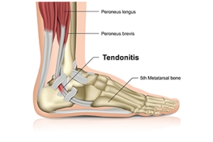 Stretching and Strengthening the Achilles Tendon