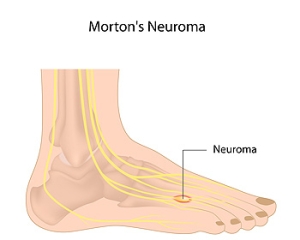 What Can Cause Morton&#039;s Neuroma?
