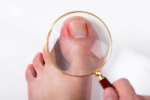 Ingrown Toenails Are a Small Problem That Can Become Serious