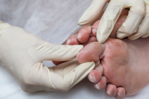 Why Diabetic Foot Care Matters