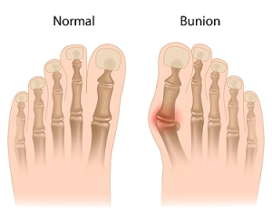 Causes and Treatment of Bunions