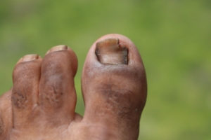 Visit a Podiatrist for Toenail Fungus