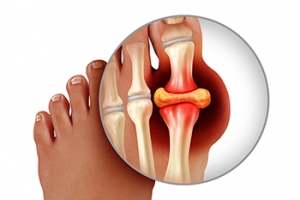 Definition, Causes, and Avenues of Treatment for Gout