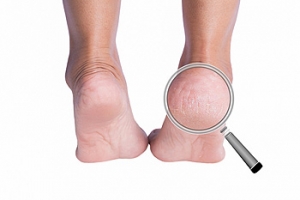 A Deeper Look at Adult Heel Fissures